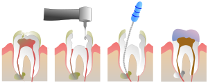 endodonti