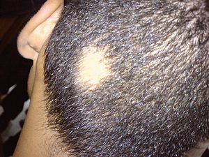 alopecia areata