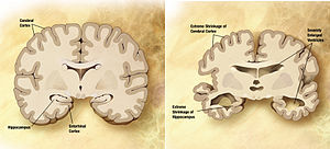 Alzheimer Hastalığı