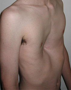 Pectus Excavatum