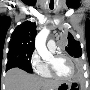 Mezotelyoma