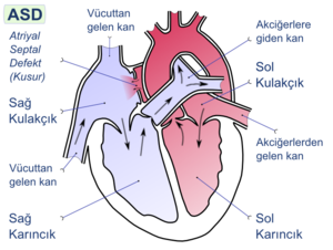 Atriyal septal defekt