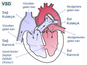 Ventriküler septal defekt