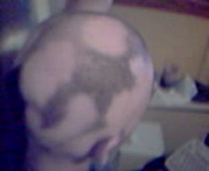 Alopesi Totalis