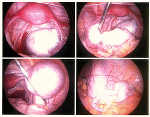 Endometriozis