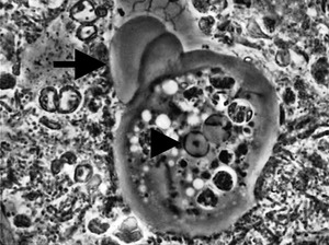 Entamoeba gingivalis