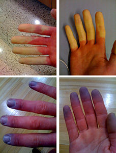 Raynaud olgusu