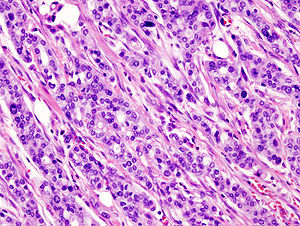 adenocarcinoma