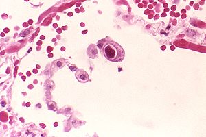 cytomegalovirus