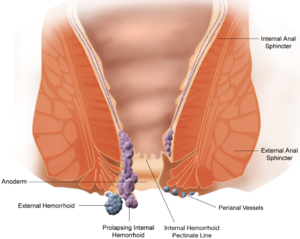 hemoroid