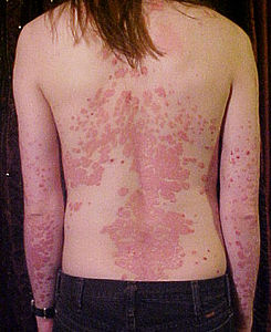 Psoriasis