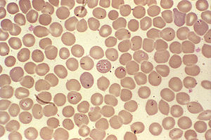 babesiosis